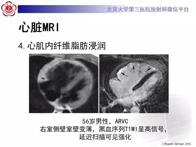 【病例】致心率失常性心肌病1例MR
