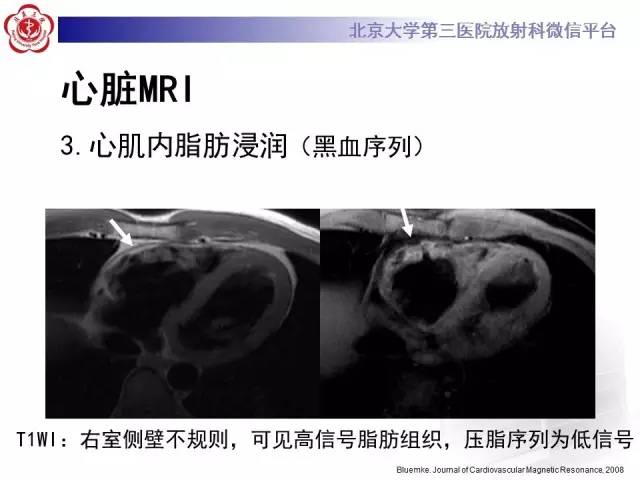 【病例】致心率失常性心肌病1例MR
