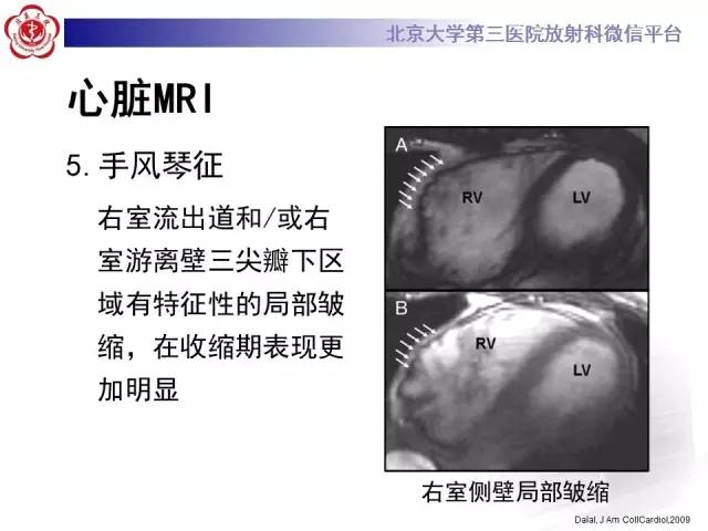 【病例】致心率失常性心肌病1例MR