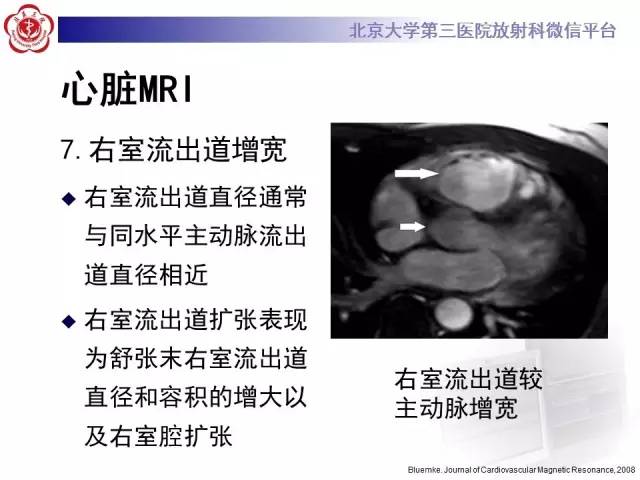 【病例】致心率失常性心肌病1例MR
