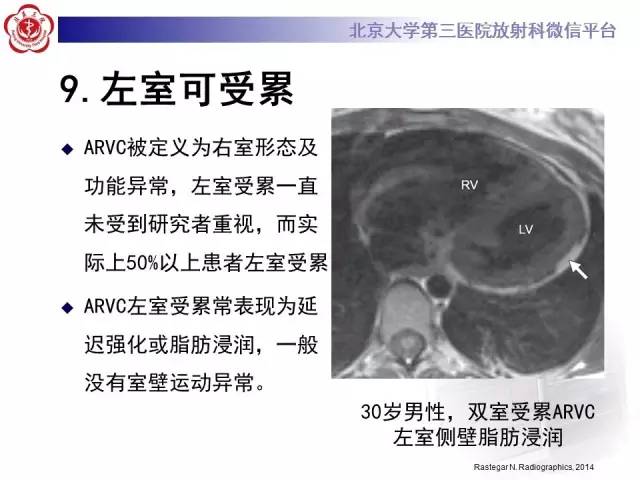 【病例】致心率失常性心肌病1例MR