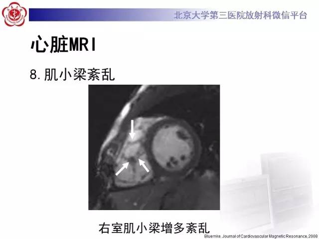 【病例】致心率失常性心肌病1例MR