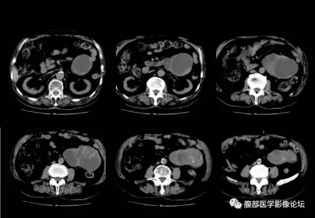 【病例】腹膜后嗜铬细胞瘤1例CT影像表现 【病例】腹膜后嗜铬细胞瘤1例CT影像表现