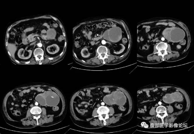 【病例】腹膜后嗜铬细胞瘤1例CT影像表现 【病例】腹膜后嗜铬细胞瘤1例CT影像表现