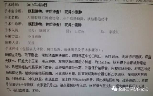 【病例】腹膜后嗜铬细胞瘤1例CT影像表现 【病例】腹膜后嗜铬细胞瘤1例CT影像表现