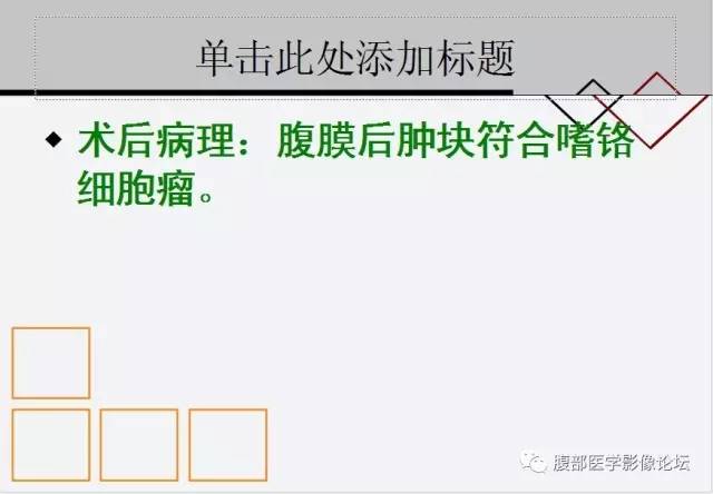 【病例】腹膜后嗜铬细胞瘤1例CT影像表现 【病例】腹膜后嗜铬细胞瘤1例CT影像表现