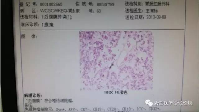 【病例】腹膜后嗜铬细胞瘤1例CT影像表现 【病例】腹膜后嗜铬细胞瘤1例CT影像表现