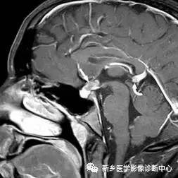 看到垂体柄异常，要想到的18种疾病