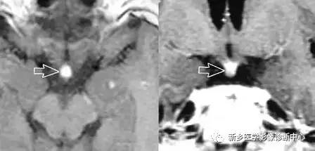 看到垂体柄异常，要想到的18种疾病