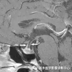 看到垂体柄异常，要想到的18种疾病