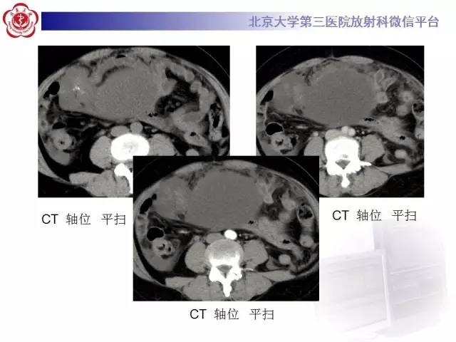 【病例】阑尾粘液性肿瘤1例CT及MR影像表现与鉴别