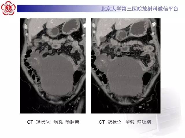 【病例】阑尾粘液性肿瘤1例CT及MR影像表现与鉴别