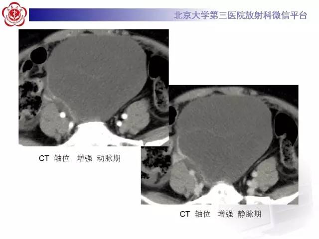 【病例】阑尾粘液性肿瘤1例CT及MR影像表现与鉴别