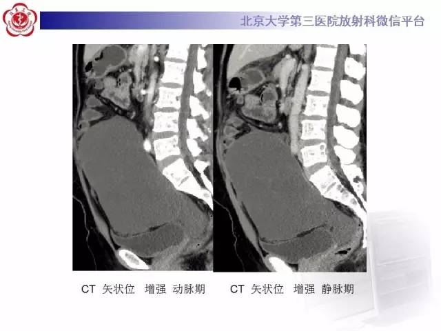 【病例】阑尾粘液性肿瘤1例CT及MR影像表现与鉴别
