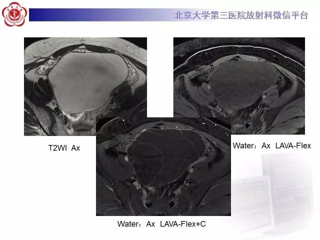 【病例】阑尾粘液性肿瘤1例CT及MR影像表现与鉴别