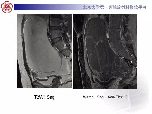 【病例】阑尾粘液性肿瘤1例CT及MR影像表现与鉴别