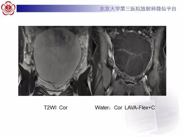 【病例】阑尾粘液性肿瘤1例CT及MR影像表现与鉴别