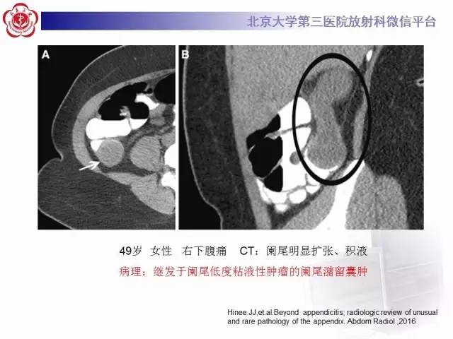 【病例】阑尾粘液性肿瘤1例CT及MR影像表现与鉴别