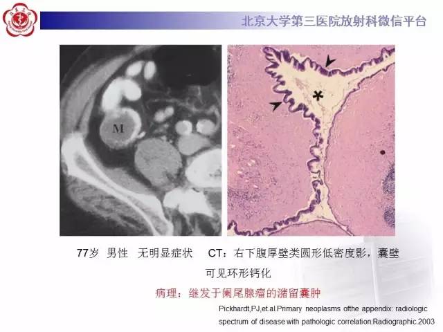 【病例】阑尾粘液性肿瘤1例CT及MR影像表现与鉴别