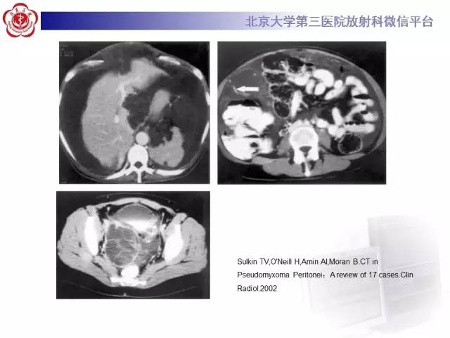 【病例】阑尾粘液性肿瘤1例CT及MR影像表现与鉴别