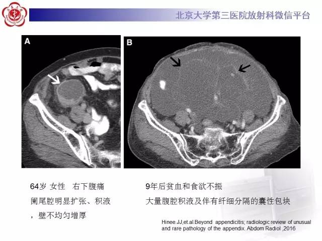 【病例】阑尾粘液性肿瘤1例CT及MR影像表现与鉴别