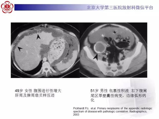 【病例】阑尾粘液性肿瘤1例CT及MR影像表现与鉴别