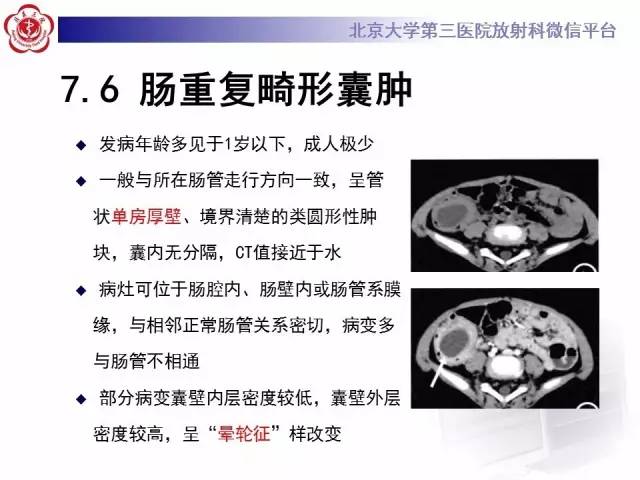 【病例】阑尾粘液性肿瘤1例CT及MR影像表现与鉴别