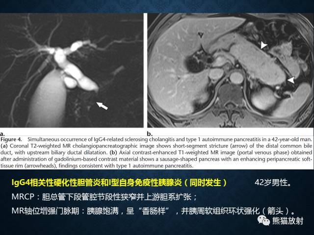 【专题】“对应性胆胰疾病”的影像表现 【专题】“对应性胆胰疾病”的影像表现
