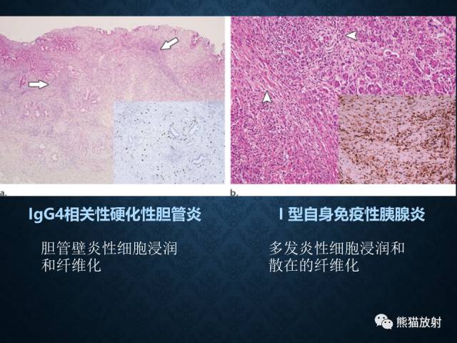 【专题】“对应性胆胰疾病”的影像表现 【专题】“对应性胆胰疾病”的影像表现