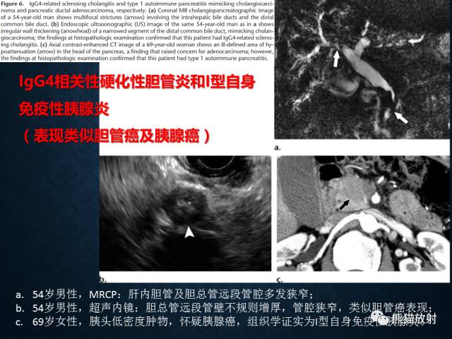 【专题】“对应性胆胰疾病”的影像表现 【专题】“对应性胆胰疾病”的影像表现