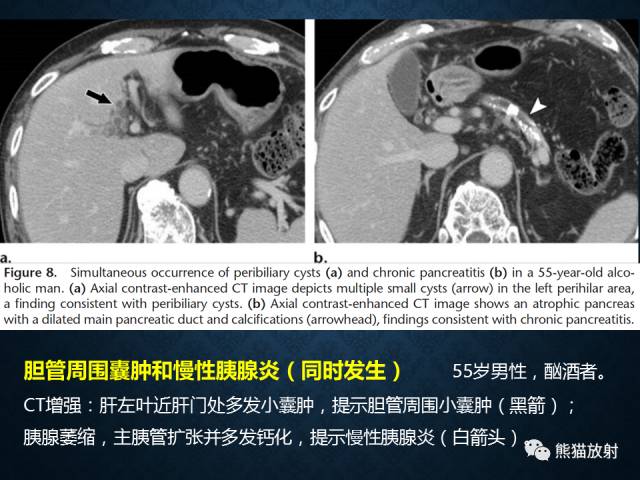 【专题】“对应性胆胰疾病”的影像表现 【专题】“对应性胆胰疾病”的影像表现