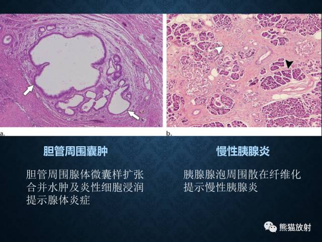 【专题】“对应性胆胰疾病”的影像表现 【专题】“对应性胆胰疾病”的影像表现