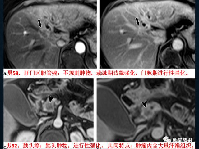 【专题】“对应性胆胰疾病”的影像表现 【专题】“对应性胆胰疾病”的影像表现