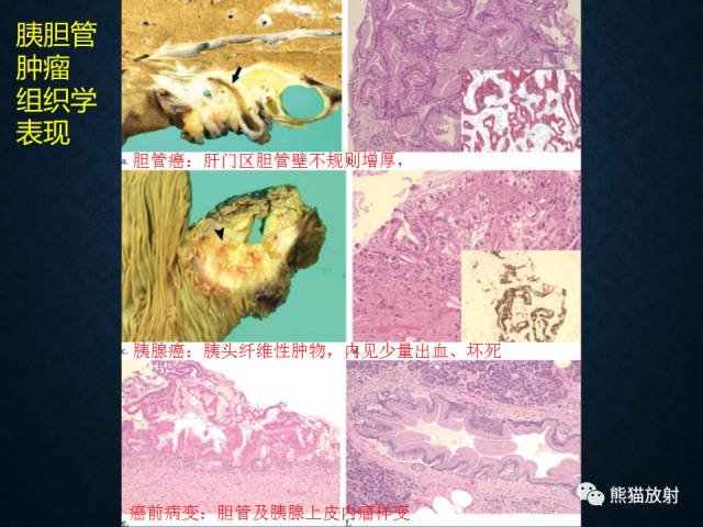 【专题】“对应性胆胰疾病”的影像表现 【专题】“对应性胆胰疾病”的影像表现