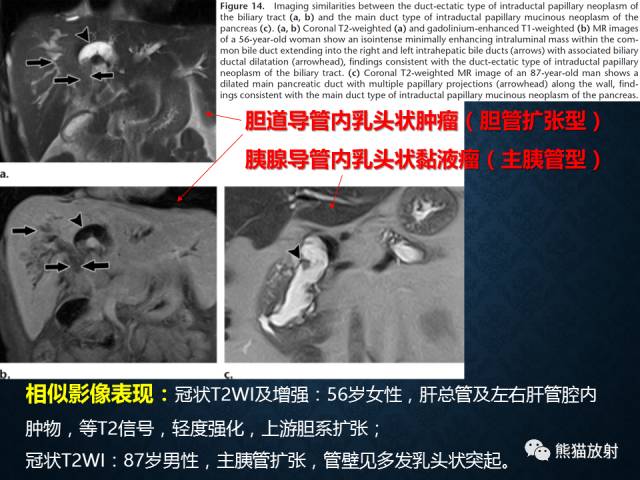 【专题】“对应性胆胰疾病”的影像表现 【专题】“对应性胆胰疾病”的影像表现