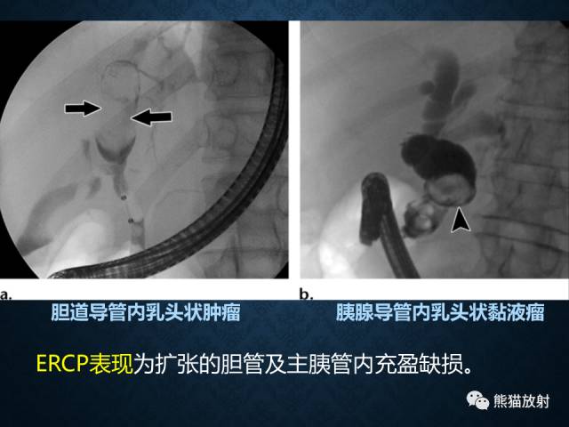 【专题】“对应性胆胰疾病”的影像表现 【专题】“对应性胆胰疾病”的影像表现