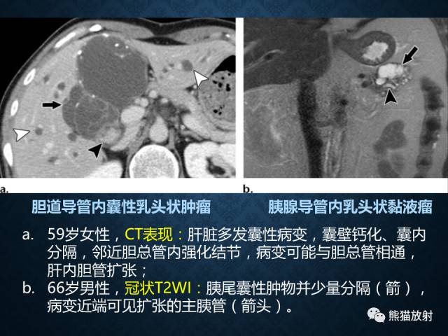 【专题】“对应性胆胰疾病”的影像表现 【专题】“对应性胆胰疾病”的影像表现