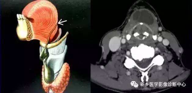 颈部囊性病变,要想到的16种疾病 颈部囊性病变,要想到的16种疾病