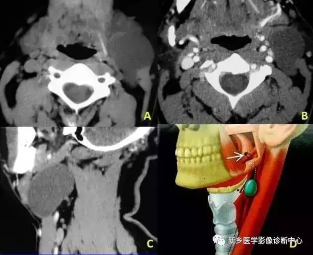 颈部囊性病变，要想到的16种疾病