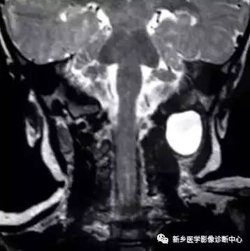 颈部囊性病变,要想到的16种疾病 颈部囊性病变,要想到的16种疾病