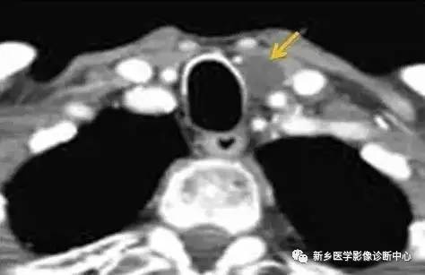 颈部囊性病变,要想到的16种疾病 颈部囊性病变,要想到的16种疾病