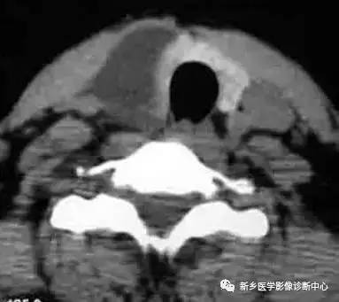 颈部囊性病变,要想到的16种疾病 颈部囊性病变,要想到的16种疾病
