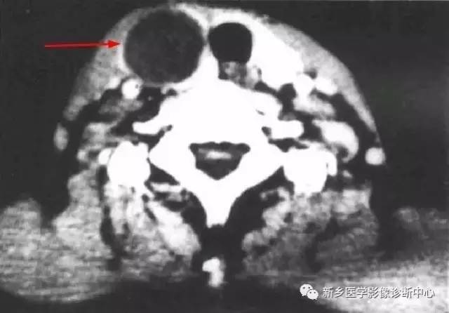 颈部囊性病变,要想到的16种疾病 颈部囊性病变,要想到的16种疾病