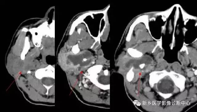 颈部囊性病变,要想到的16种疾病 颈部囊性病变,要想到的16种疾病