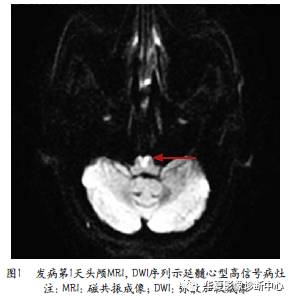 【病例】典型“心型”影像征的双侧延髓内侧梗死1例