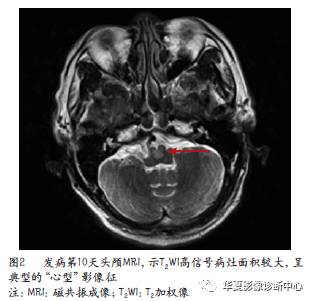 【病例】典型“心型”影像征的双侧延髓内侧梗死1例 【病例】典型“心型”影像征的双侧延髓内侧梗死1例