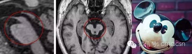 这9类影像征象分别提示哪些疾病? 这9类影像征象分别提示哪些疾病?