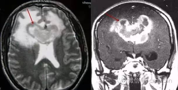 这9类影像征象分别提示哪些疾病? 这9类影像征象分别提示哪些疾病?