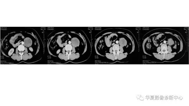 【病例】腹膜后神经鞘瘤1例CT影像表现