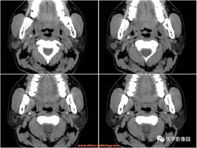 【病例】腮腺基底细胞腺瘤1例CT影像表现 【病例】腮腺基底细胞腺瘤1例CT影像表现